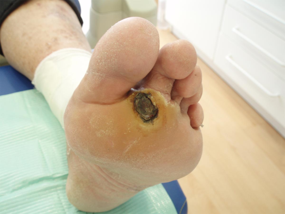 El pie diabético es una patología que se presenta en personas con diabetes en forma de heridas infectadas, pérdida de sensibilidad y la frecuente aparición de úlceras.