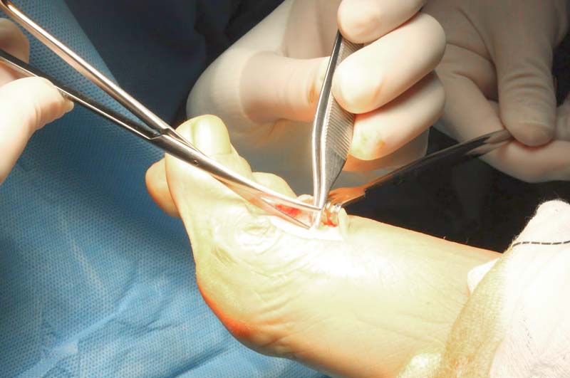 Cirugía ambulatoria de pequeñas afecciones del pie. Sant Boi - Barcelona